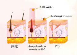 SYSTEMAT IPL VELVET epilátor odstraňovač chloupků (růžový)